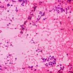 Yapay Zeka Destekli Lösemi ve Lenfoma Teşhisi