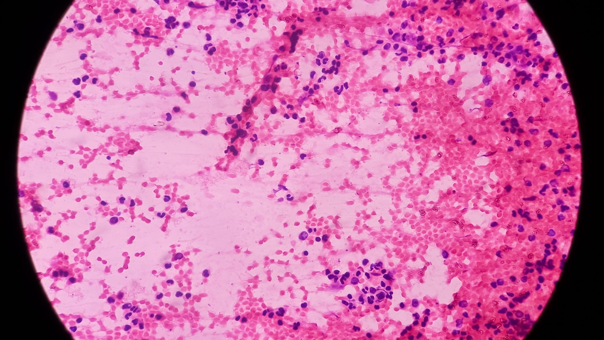 Yapay Zeka Destekli Lösemi ve Lenfoma Teşhisi