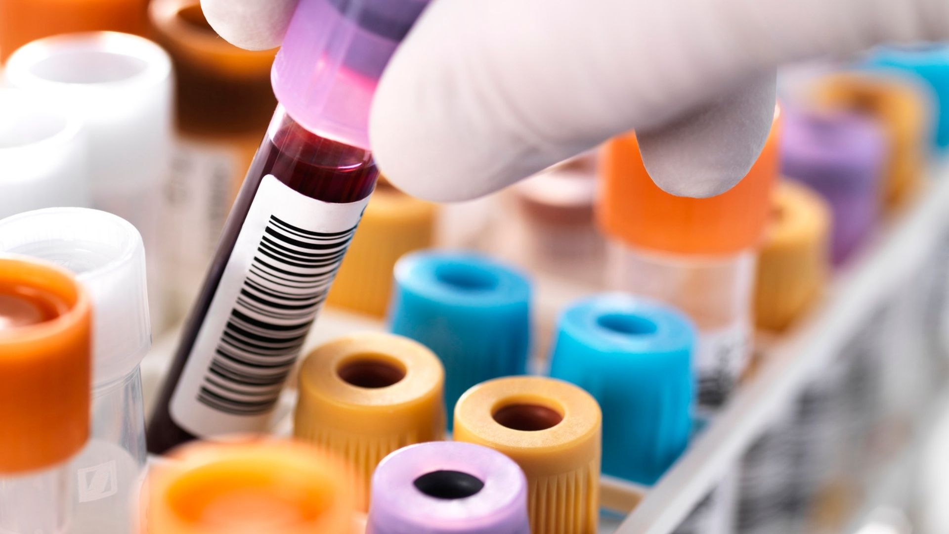 Yapay Zeka Öğrenimi ile Hematolojik Hastalıkların Teşhisi