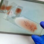 Yapay Zeka ile Hematolojik Hastalıkların Yönetimi: Klinik Karar Süreçlerinde Dijital Dönüşüm